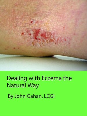 cover image of Dealing with Eczema the Natural Way